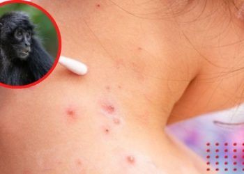 Viruela del mono: ¿cómo se contagia, síntomas y en qué países se ha detectado?