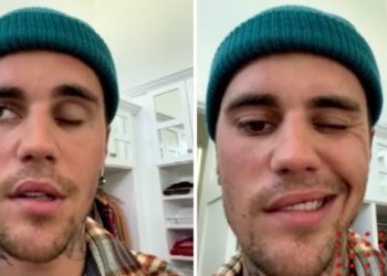 ¿Qué es el síndrome de Ramsay Hunt que tiene Justin Bieber?