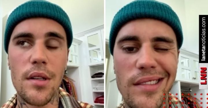 ¿Qué es el síndrome de Ramsay Hunt que tiene Justin Bieber?
