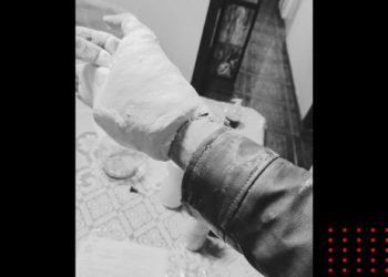 Le ponen yeso en el IMSS y no se puede quitar chamarra