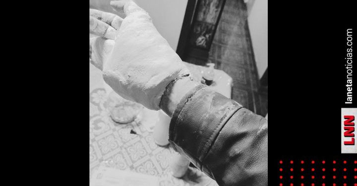 Le ponen yeso en el IMSS y no se puede quitar chamarra