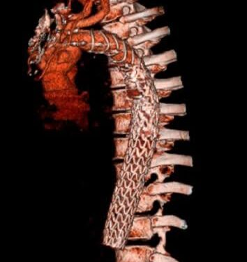 Realiza Hospital “Elvia Carrillo Puerto” del ISSSTE en Mérida cirugías de aorta con técnica Trompa de Elefante Congelada