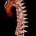 Realiza Hospital “Elvia Carrillo Puerto” del ISSSTE en Mérida cirugías de aorta con técnica Trompa de Elefante Congelada